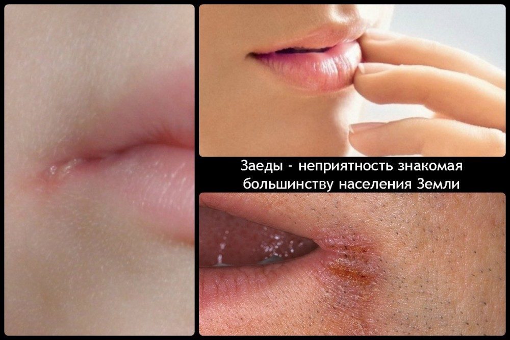 Ангулярный хейлит (заеды)