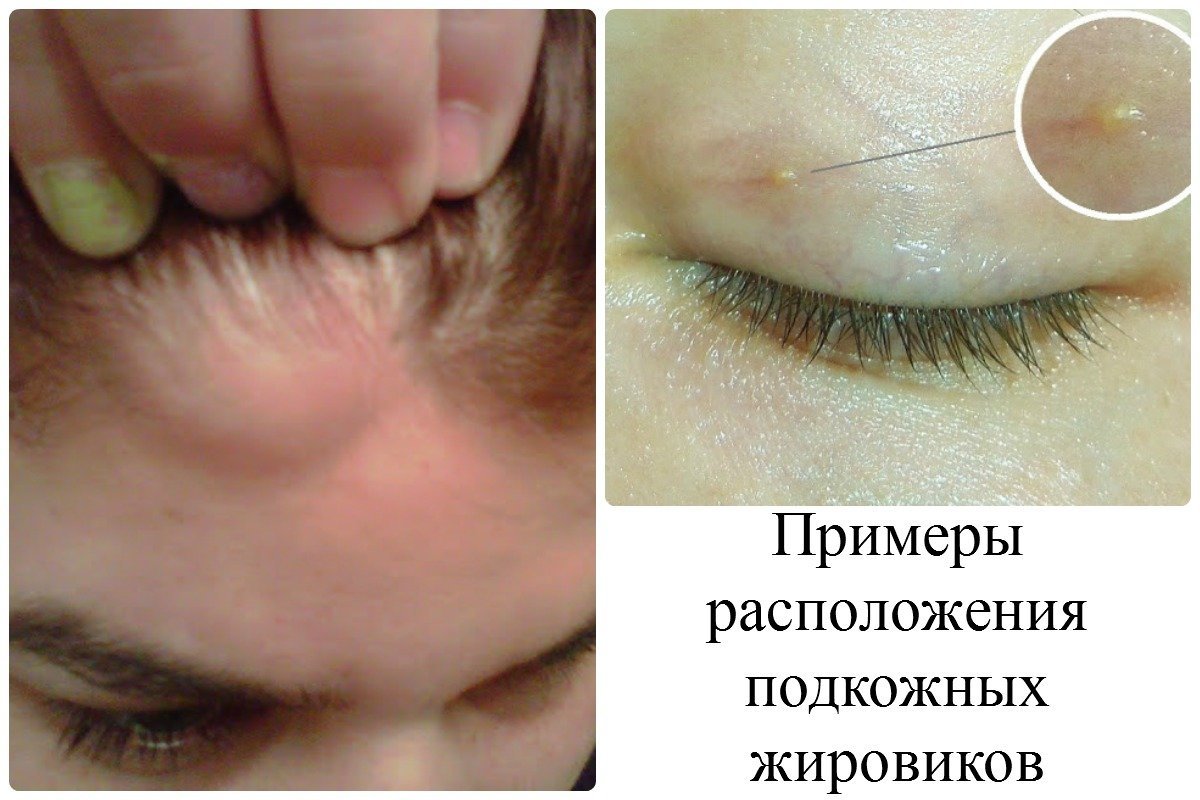 Как убрать жировик на голове в домашних условиях