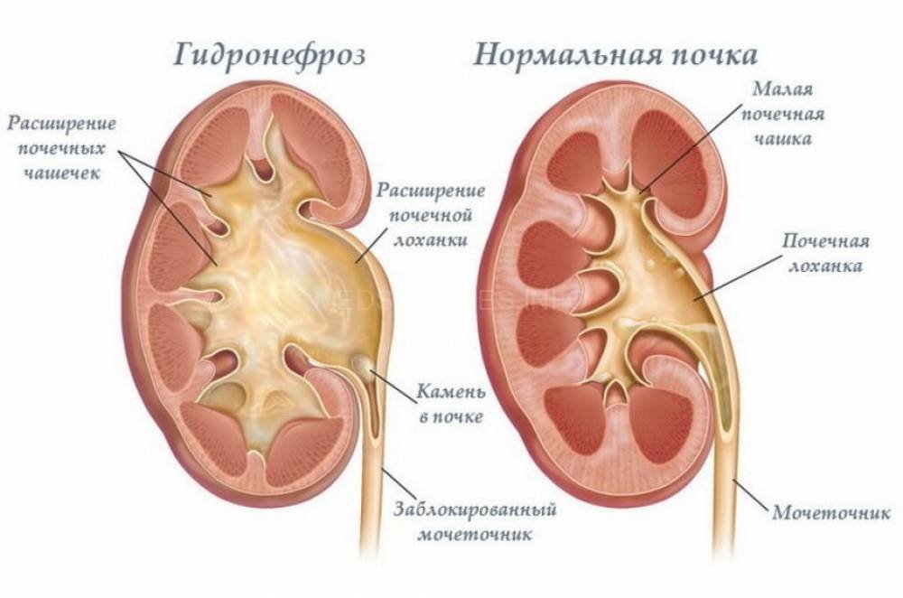 Как лечить расширение лоханки почек у взрослых Как лечить расширение лоханки почек у взрослых