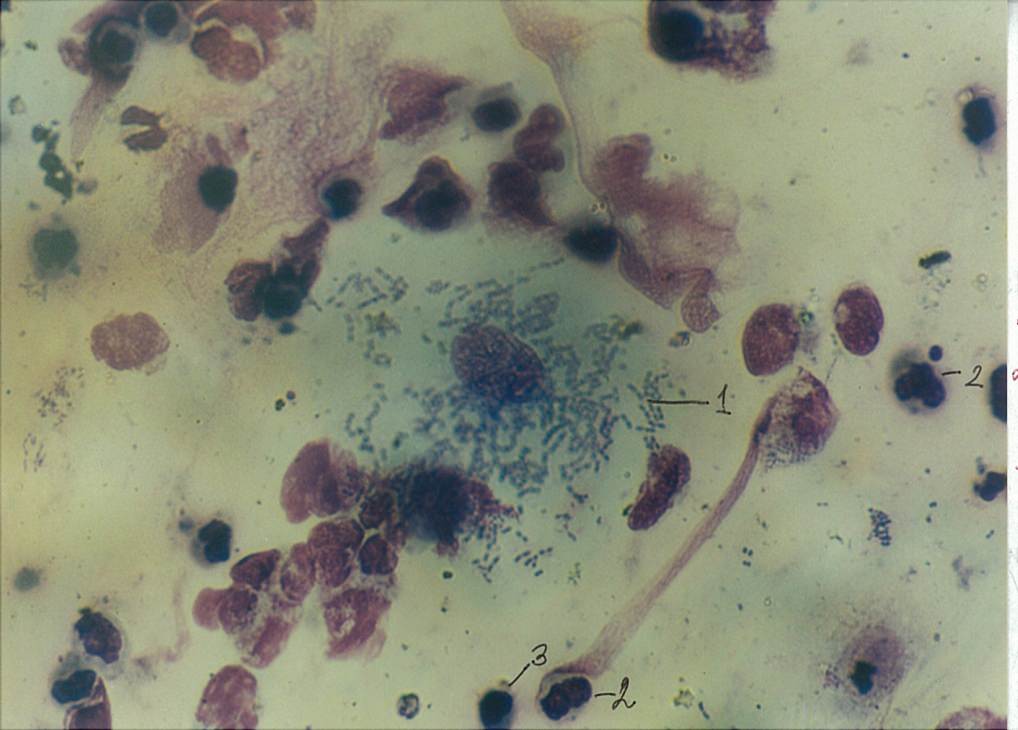 Повышенные лейкоциты в слизи. Цилиндрический эпителий в мазке из носа. Слизь в мазке под микроскопом. Сок простаты под микроскопом. Мазок мочи под микроскопом.
