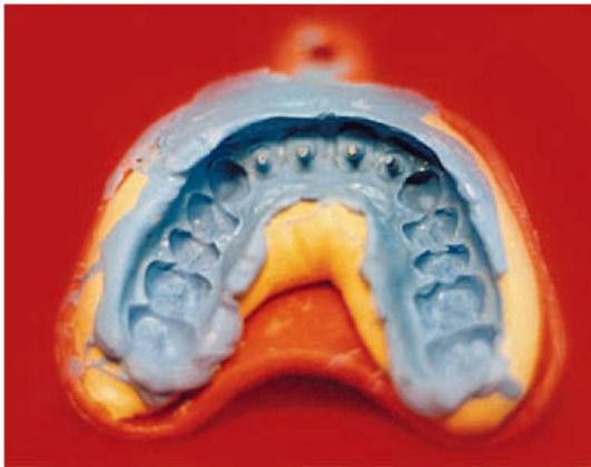 Оттиск для вкладки. Слепки и модели челюстей. Оттиск для вкладки. Двухфазный двухэтапный оттиск. Оттиск для вкладки.