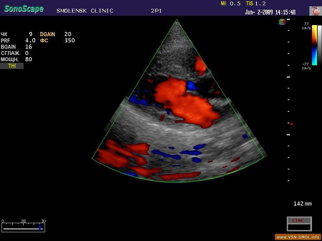 Эхокардиография с допплеровским анализом. Цветовое допплеровское ультразвуковое исследование. УЗИ сердца с цветным допплером. Допплеровское исследование сердца и сосудов. Цветовое допплеровское картирование сердца.