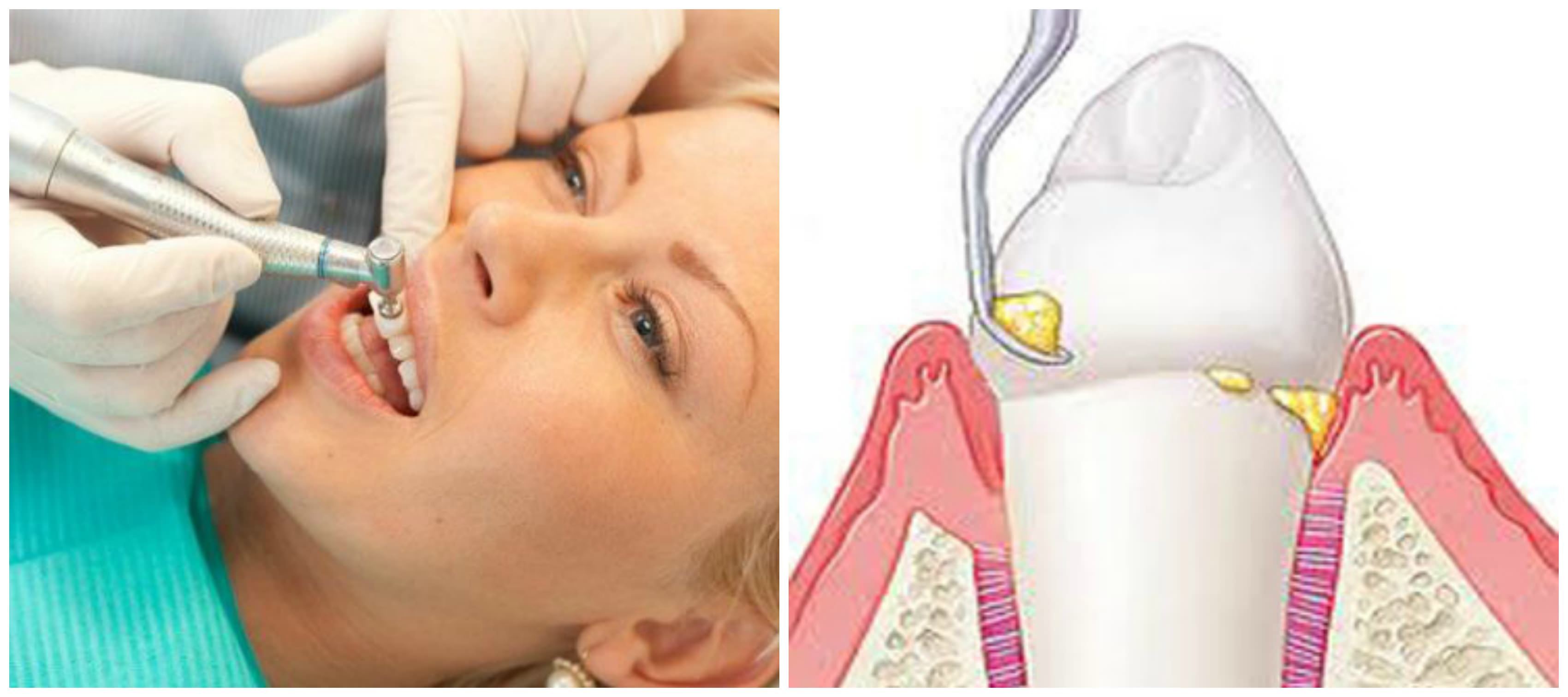 показания и противопоказания к ультразвуковой чистке зубов. пришеечный зубной налет. чистые зубы. профгигиена полости рта air flow. профгигиена полости рта.