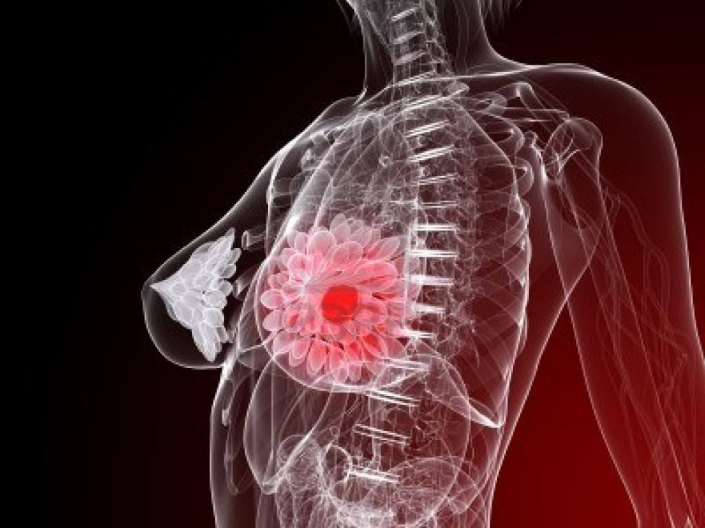 1357770732_7248755-female-anatomy-with-tumor-in-breast