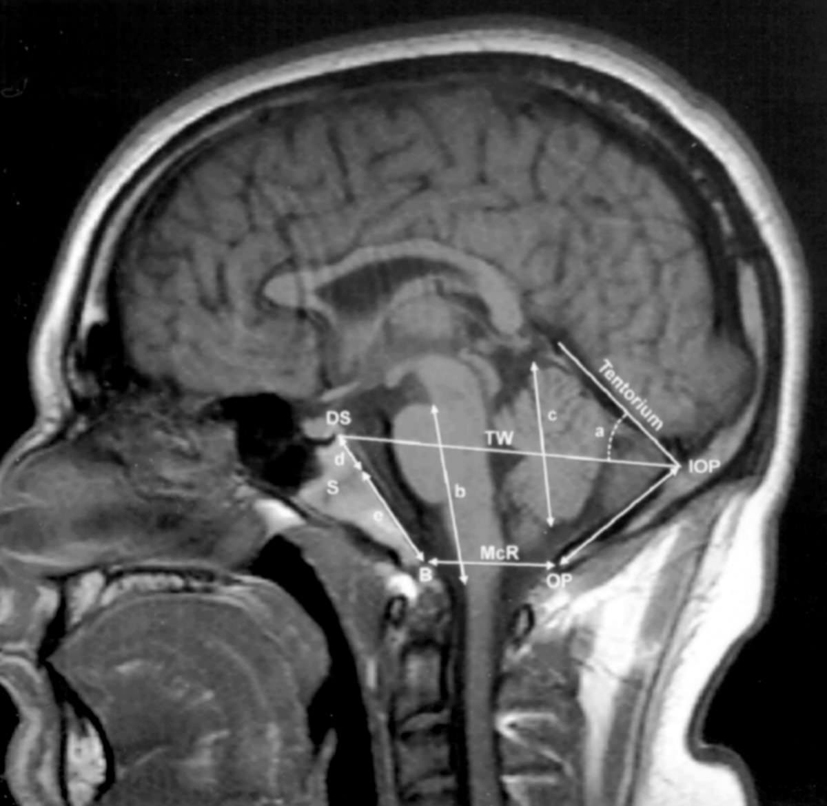 Chiari MRI diagnosis Новообразования головного мозга
