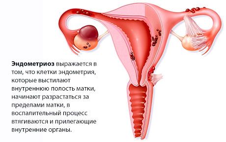 Endometrioz – novyye issledovaniya pomogut vyyasnit prichinu zabolevaniya Эндометриоз мочевого пузыря и мочевыводящих путей