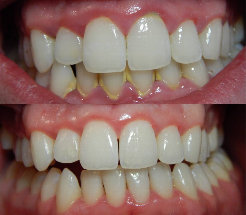 Gingivitis-before-and-after-3