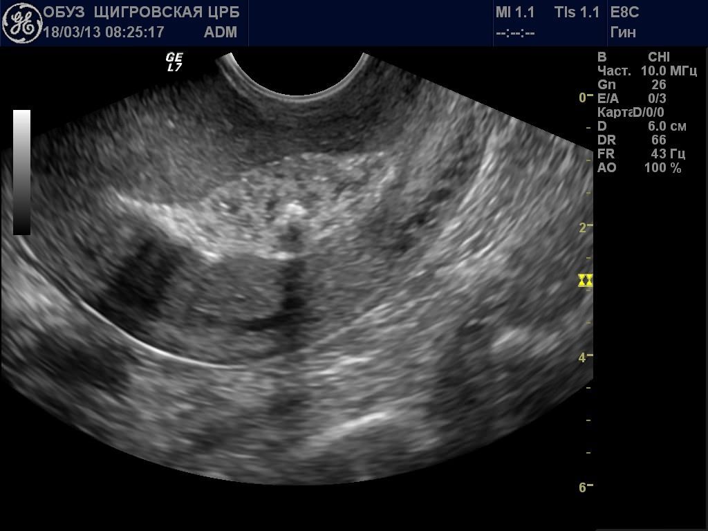 Image1117 Зональная анатомия тела матки