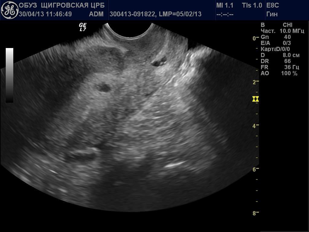 Image1914 Зональная анатомия тела матки
