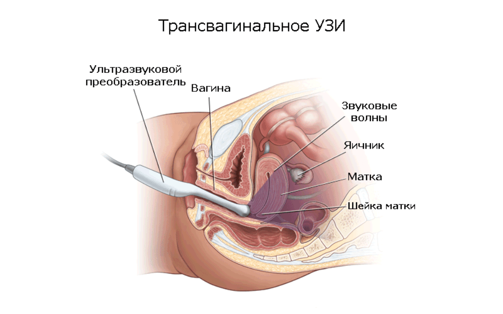 Kartinki dlya perevoda Трансвагинальное сканирование