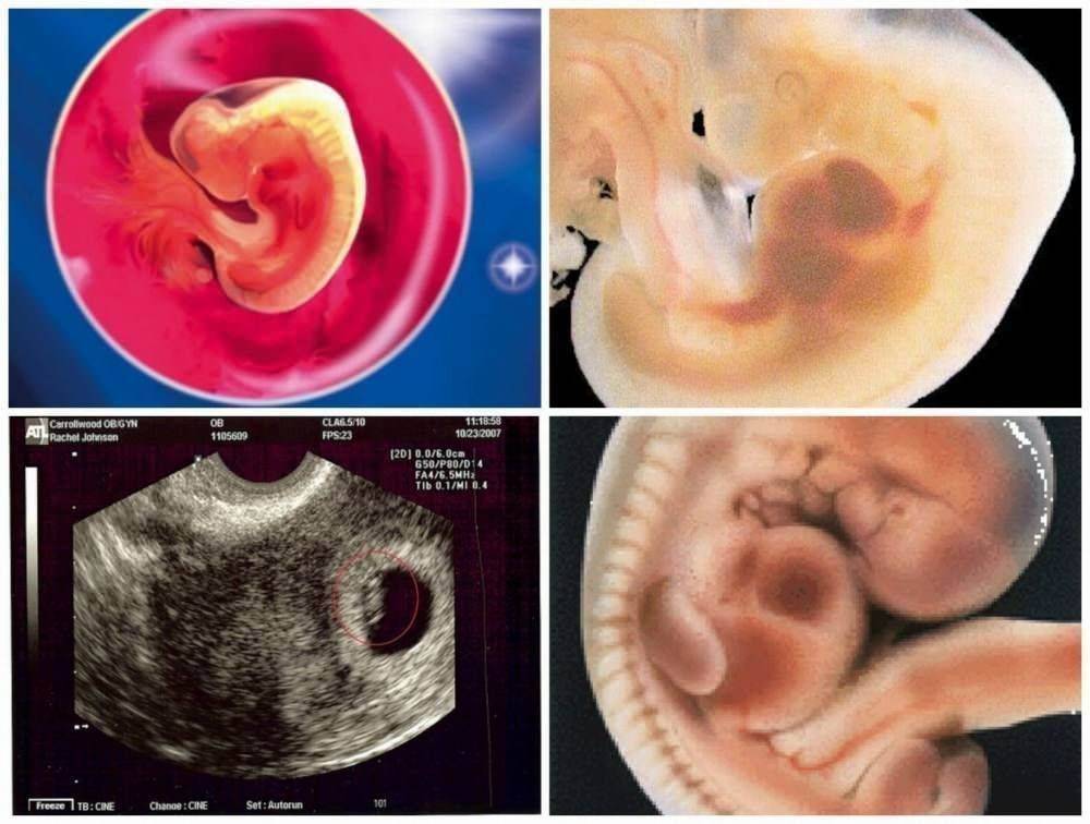 PicMonkey Collage89 Клиническое течение беременности