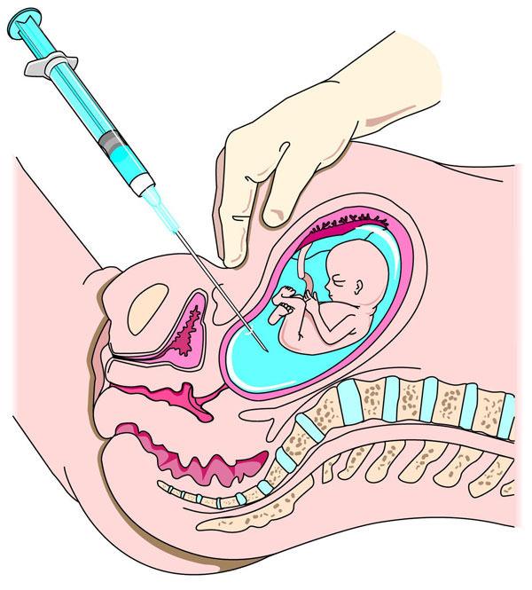 amniocentez Акушерство: инвазивные процедуры