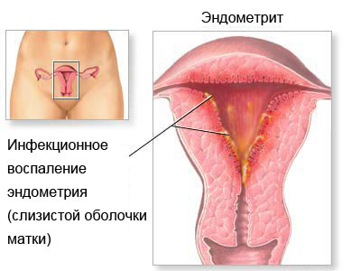 endometrium Магнитно-резонансная диагностика хронического метроэндометрита