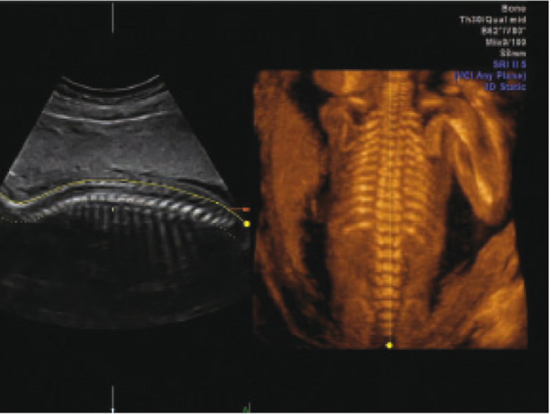 fetal spine spine fetus in ii trimester Протокол сканирования позвоночника