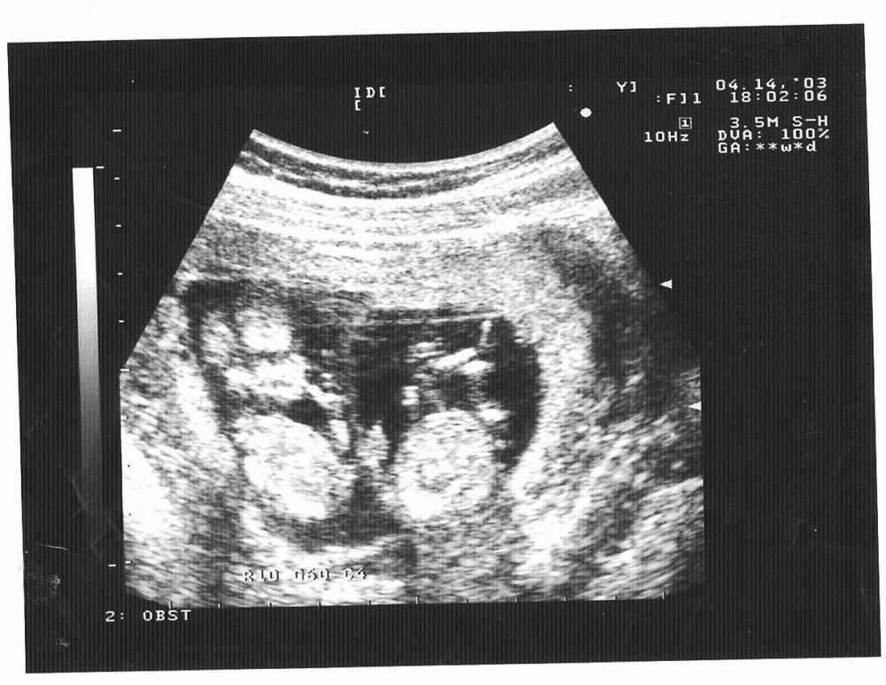 im84 Многоплодная беременность