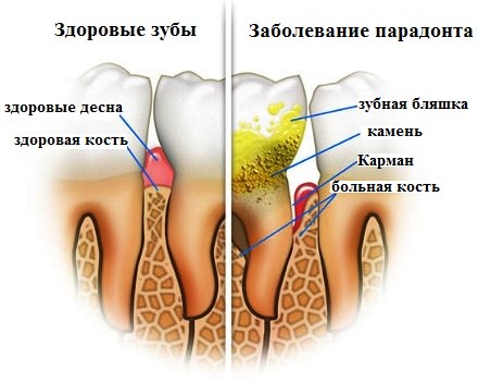 obrazovanie-zubnogo-kamnya