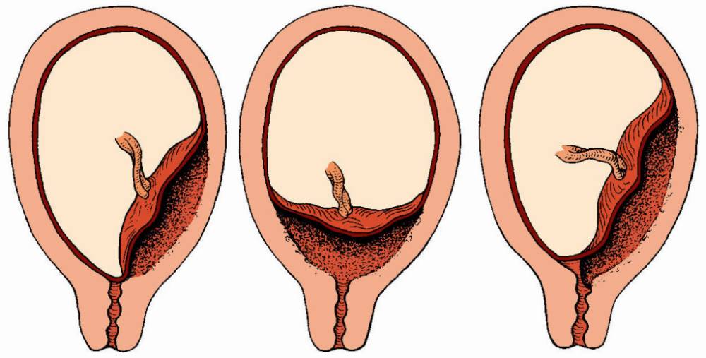 placenta1 Аномалия расположения плаценты
