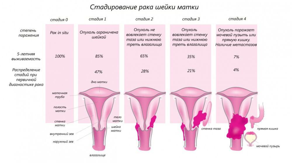 stage cervix cancer Рак шейки матки