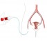 ufe catheter hires Оценка кровотока в маточных артериях