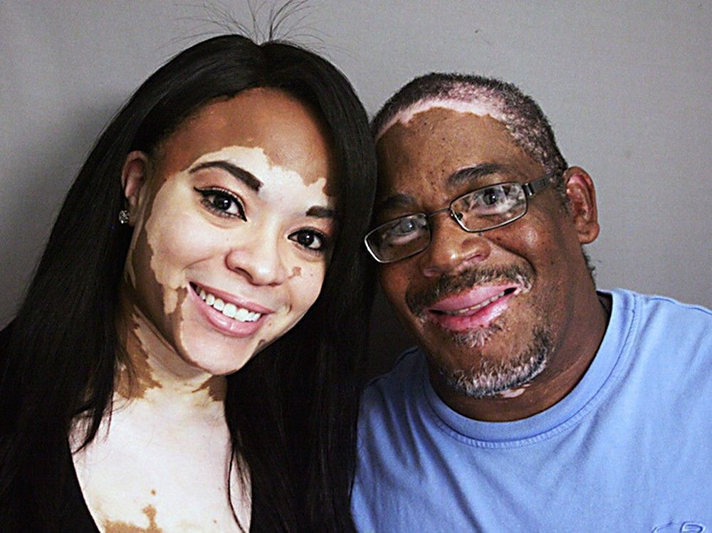 vitiligo Витилиго