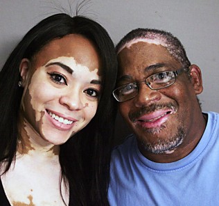 vitiligo Витилиго