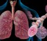 bronchial asthma Бронхиальная астма