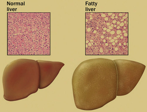 fatty liver disease types diagnosis Жировая болезнь печени: типы, диагностика