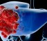 liver disease clinical manifestations Поражение печени: клинические проявления