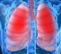 lung disease clinical manifestations Поражение легких: клинические проявления