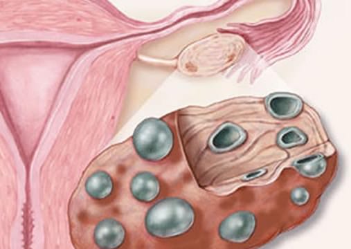 conservative therapy in polycystic ovary Консервативная терапия при поликистозе яичников