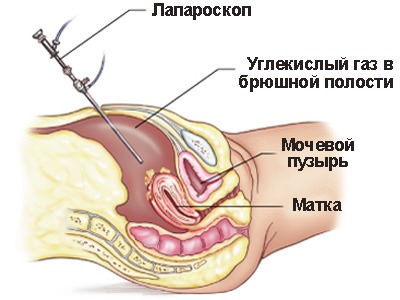 laparoscopic ovarian biopsy Лапароскопическая биопсия яичников