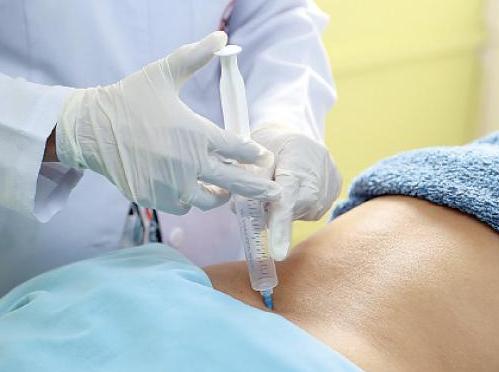 laparoscopic removal of ovarian cysts Лапароскопическое удаление кист яичников
