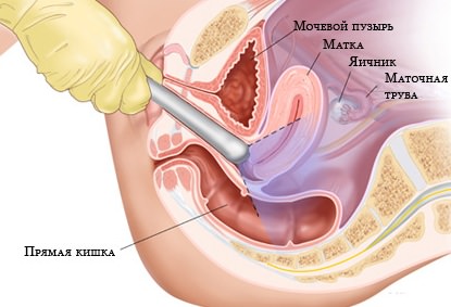 laser drilling ovarian Лазерный дриллинг яичников