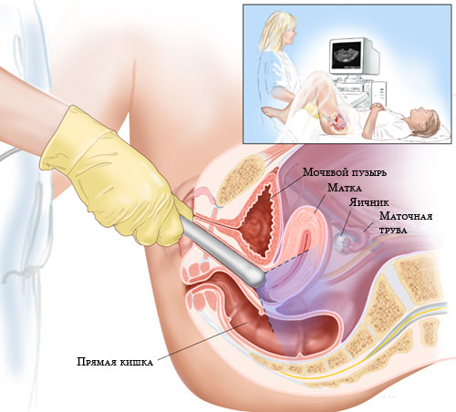 transvaginal ultrasound Трансвагинальное УЗИ