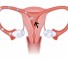 treatment of diseases of the uterus Лечение заболеваний придатков матки