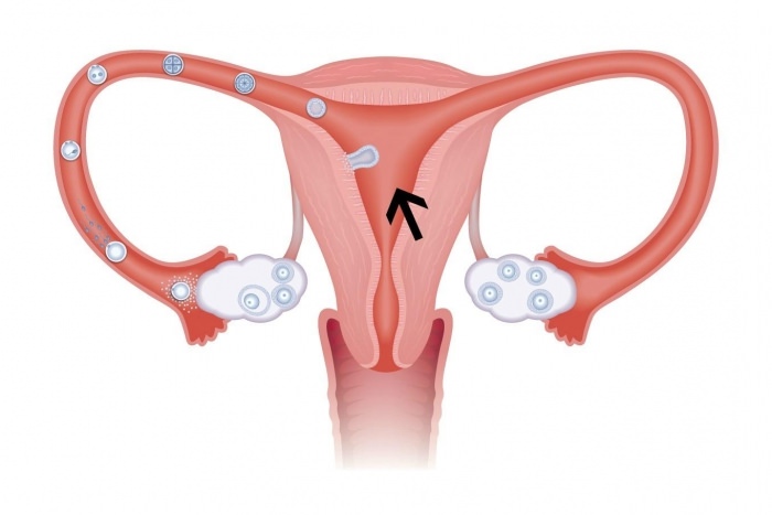 treatment of diseases of the uterus Лечение заболеваний придатков матки