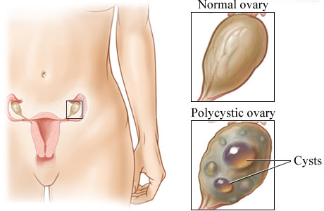 treatment of polycystic ovarian Лечение поликистоза яичников