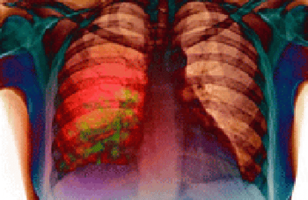 the development of pathological changes in the lungs Развитие патологических изменений в легких