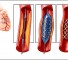 angiography grafts after coronary artery bypass surgery Ангиография шунтов после аортокоронарного шунтирования