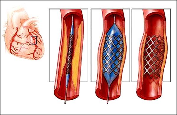 angiography grafts after coronary artery bypass surgery Ангиография шунтов после аортокоронарного шунтирования