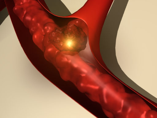 arterial embolism Артериальные эмболии