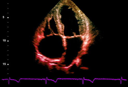 cardiac hypertrophy and heart failure Гипертрофия сердца и сердечная недостаточность