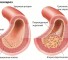 coronary atherosclerosis Коронарный атеросклероз