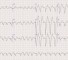 differential diagnosis of myocardial infarction Дифференциальная диагностика инфаркта миокарда