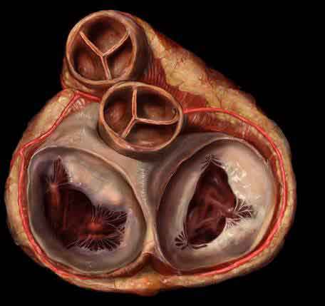 diseases of the heart valves Заболевания клапанов сердца