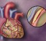 identification of high risk of coronary heart disease Идентификация высокого риска возникновения ишемической болезни сердца