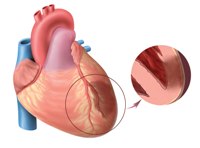 spasm of the coronary artery Спазм коронарной артерии