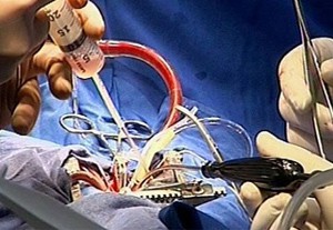 surgical revascularization Хирургическая реваскуляризация