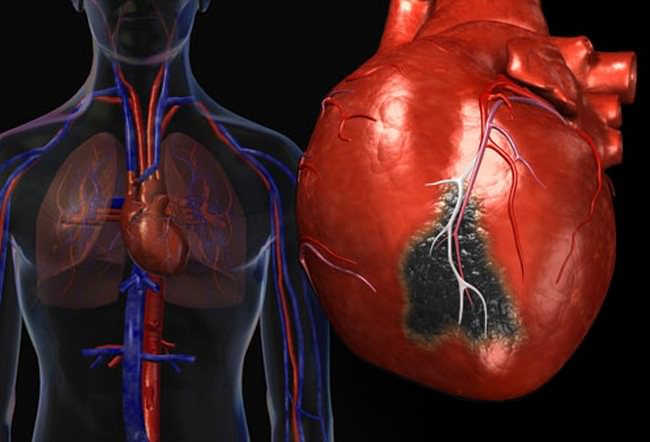 the prevalence of coronary arteries Преобладание коронарных артерий