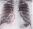 radiograph of chest before fascial artificial esophagus Рентгенограмма загрудинно-пред фасциального искусственного пищевода